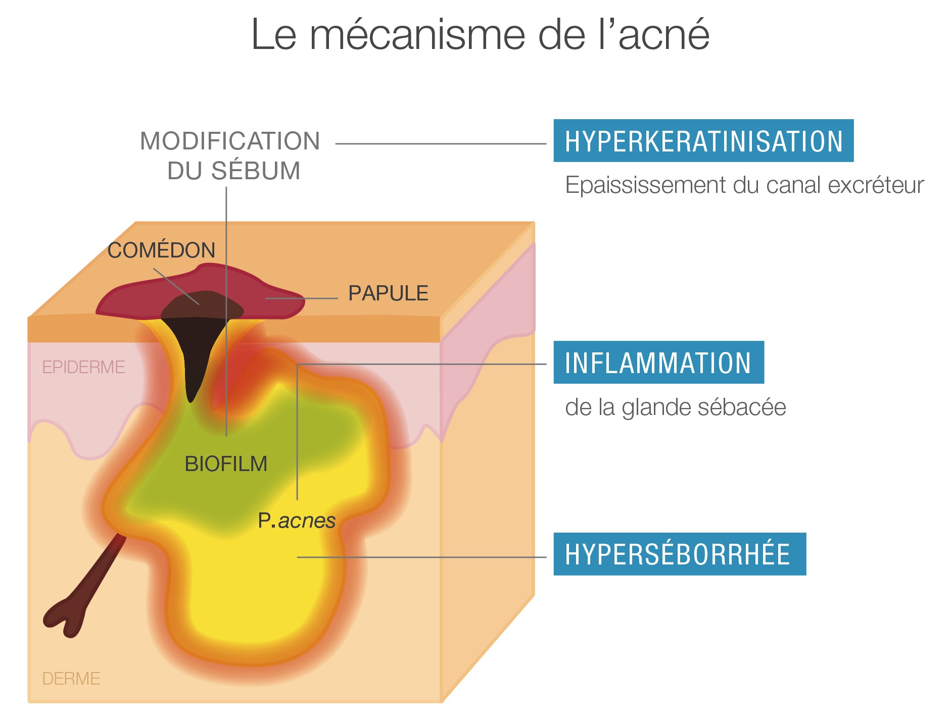 Adolescent Acne: Understanding it better to treat it better